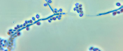 Illustration of Sporotrichosis.