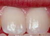 Image of very mild fluorosis. Teeth with small, paper-white opaque spots over a small area.